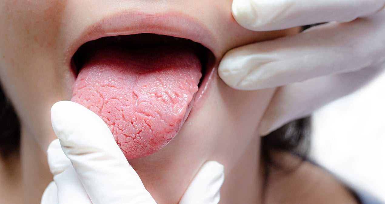 dilindeki agri kanserin habercisi cikti Kr6kRmez